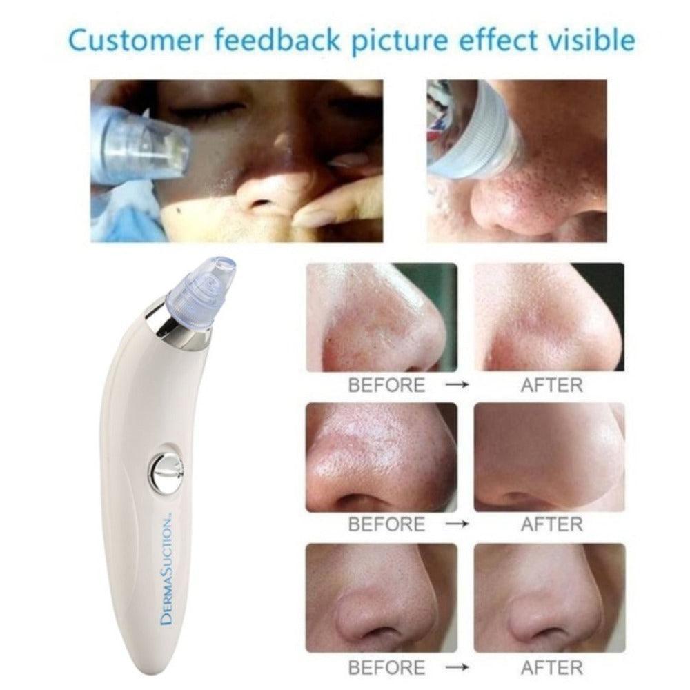 Derma Suction Blackhead Remover Zen Aural